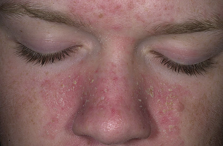 Skincare Tips to Help Seborrheic Dermatitis Dermacare