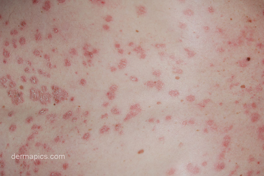 Guttate psoriasis pictures and clinical information