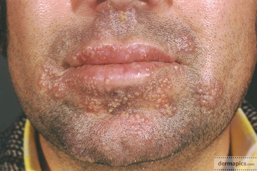 HERPES infection clinical pictures in high resolution