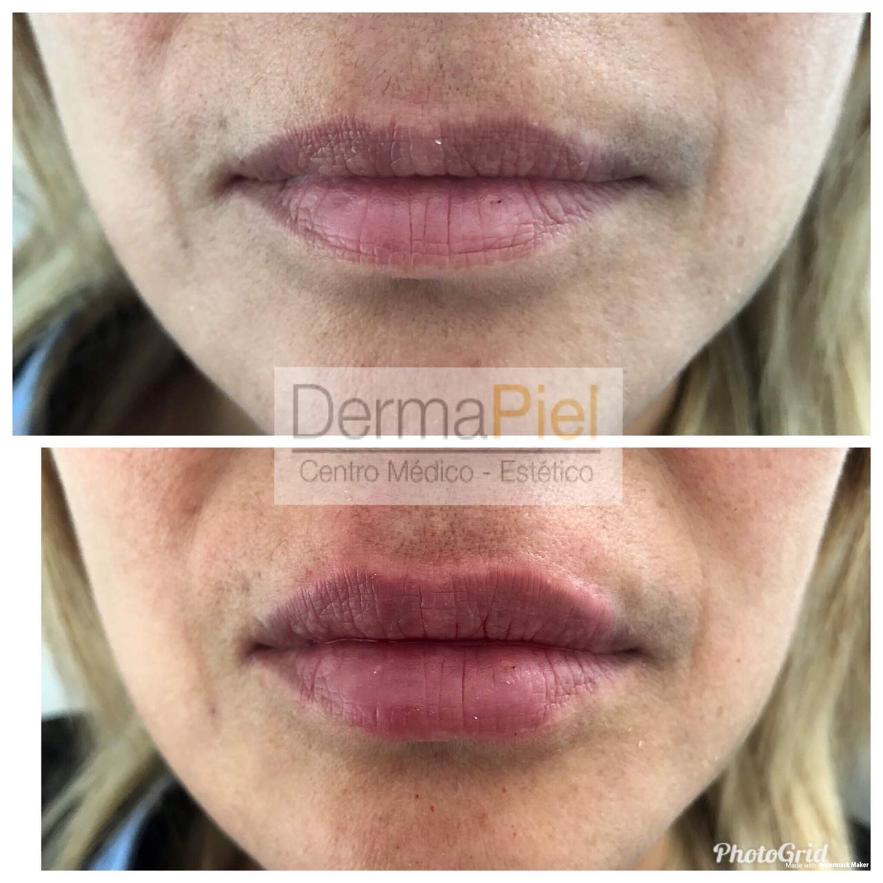labios Dermapiel