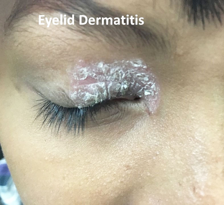 Dermatitis And Eczema Of The Eyelids