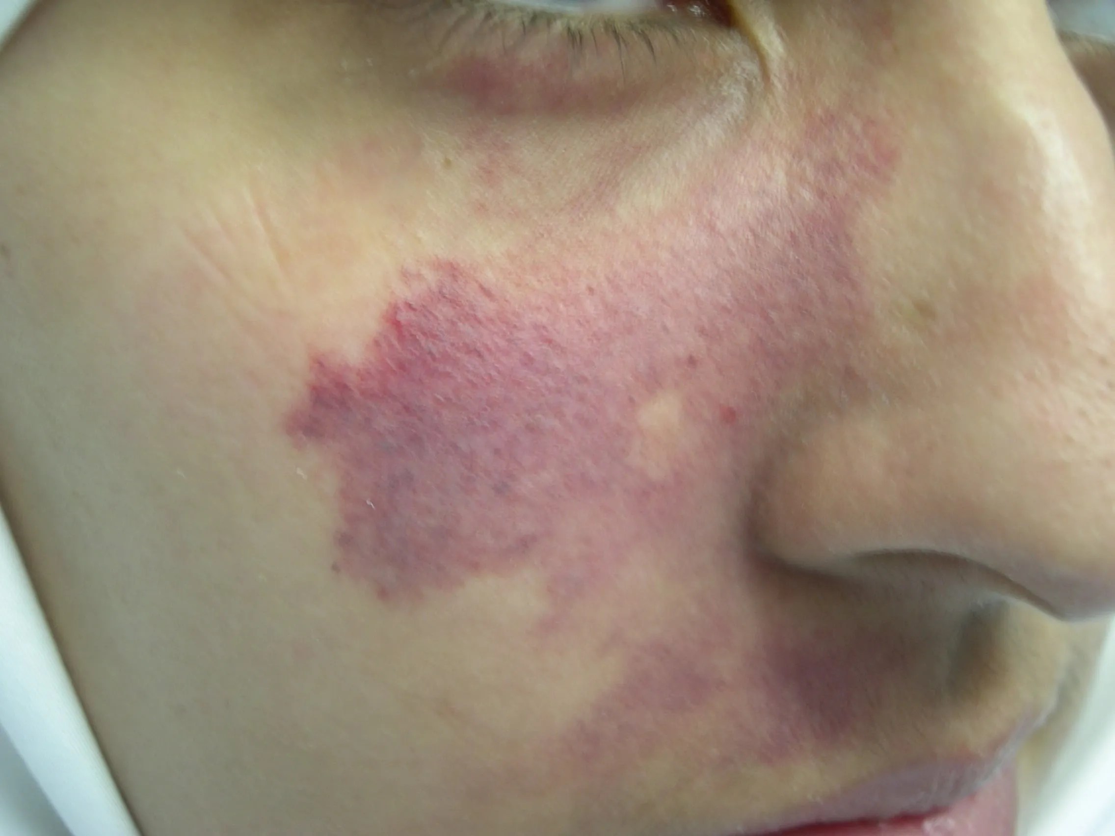 Laser Birthmark Removal Demasurge Clinic