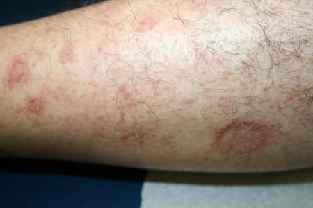 Pityriasis rosea, pityriasis circinata et maculata. Pityriasis rosea - Dermatology Advisor