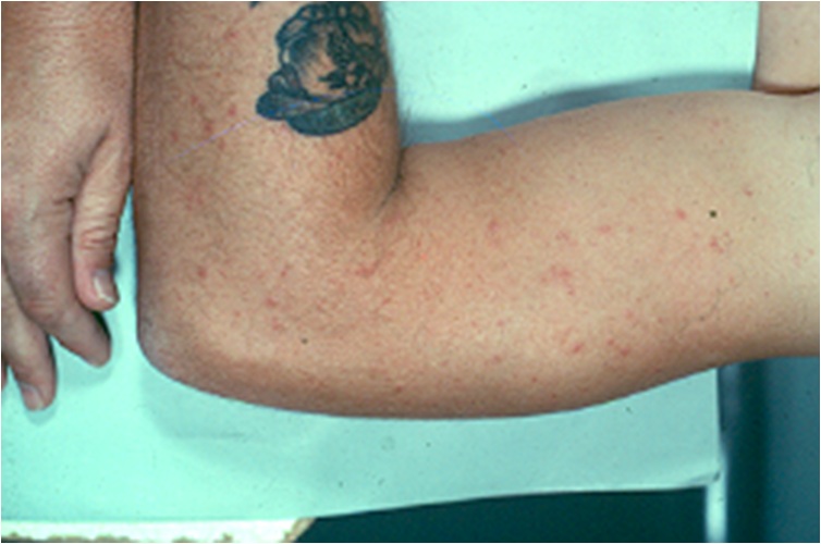 Polymorphous Light Eruption (Polymorphic light eruption, sunpoisoning