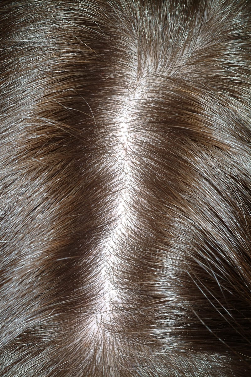 Telogen Effluvium (StressInduced Alopecia) Dermatology Advisor