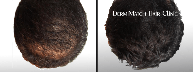Hair Loss and Scalp Health The Dandruff Connection DermiMatch Hair
