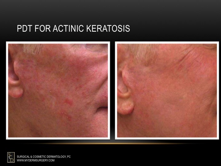 Blue Light Photodynamic Therapy For Actinic Keratosis Shelly Lighting