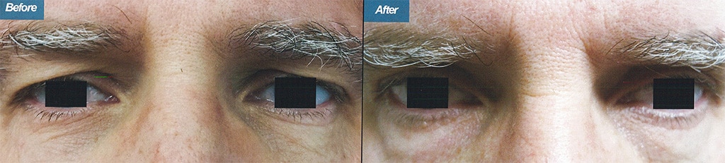 Eyelid Surgery Skin & Beauty Center Northridge, CA