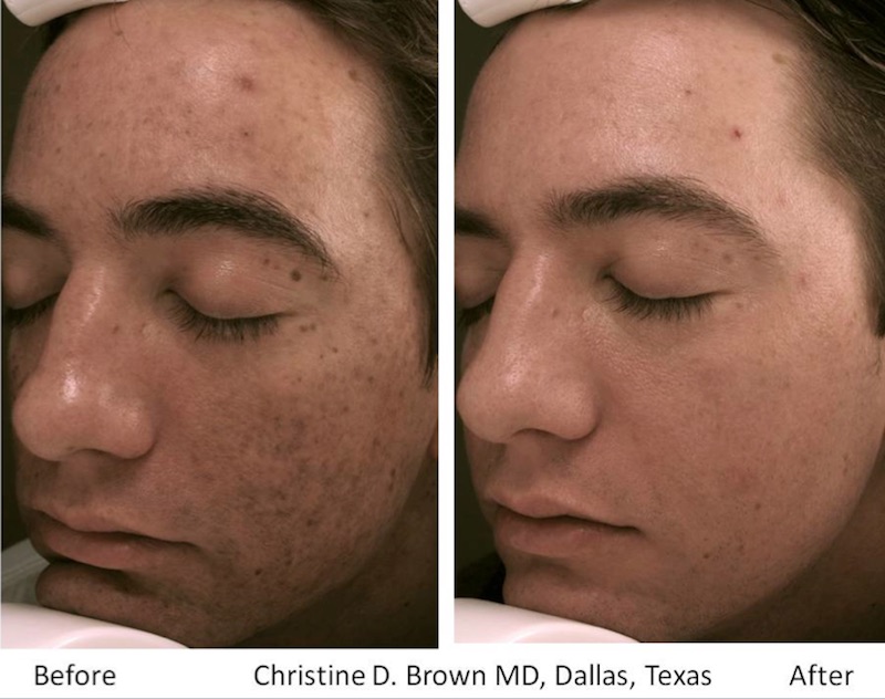 Skin Microneedling Eclipse MicroPen Houston TX New York
