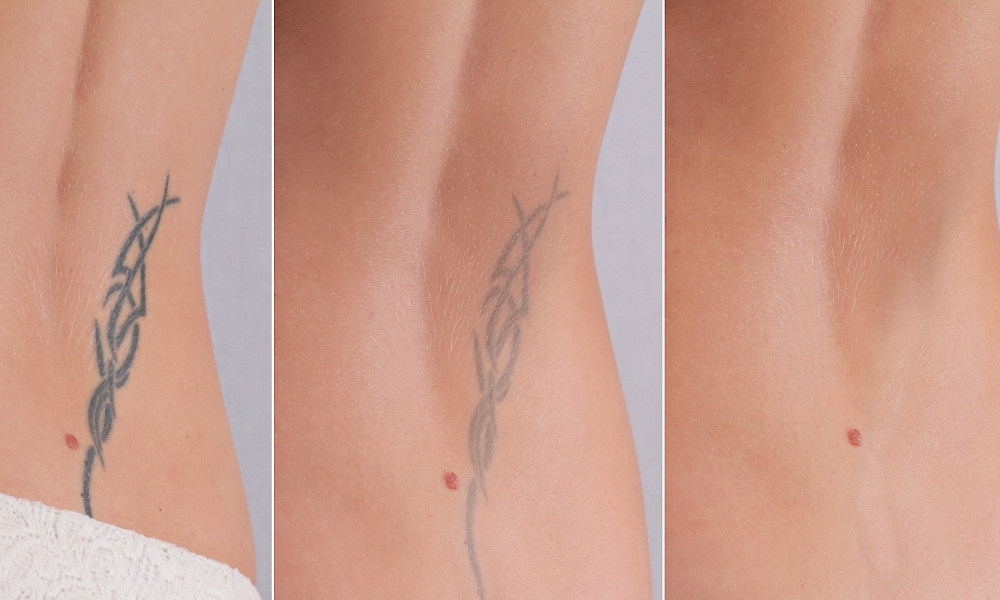 Tattoo Removal Cream Before And After Pictures Tatto Wallpapers
