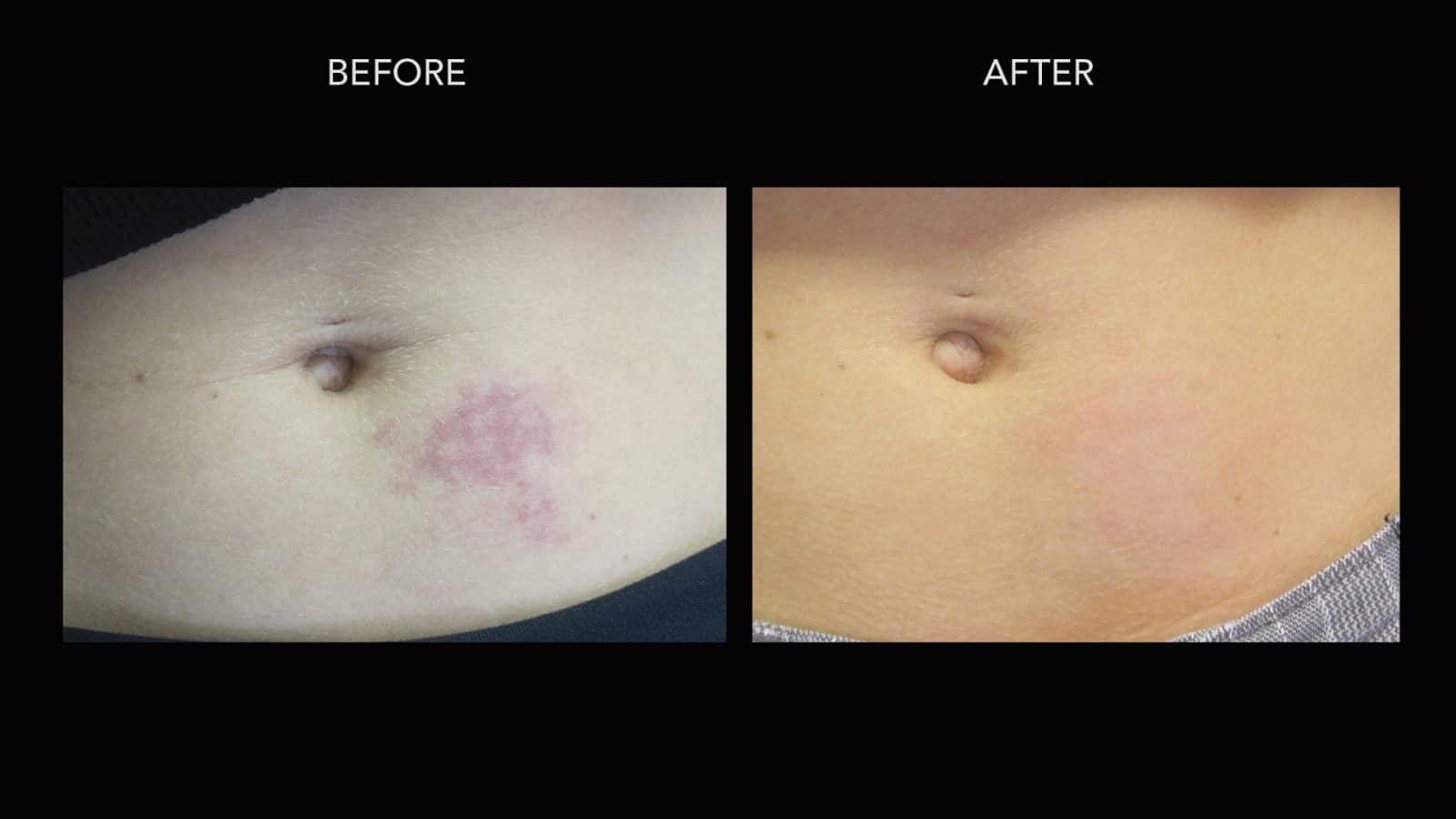 Birthmark BeforeAfter Treatment Photos DermMedica
