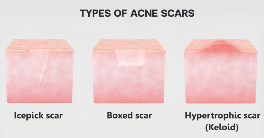 Can Scarring From Acne Be Removed? DermSurgery Associates