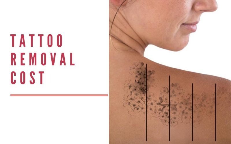 Tattoo Removal Cost in Delhi Desmoderm