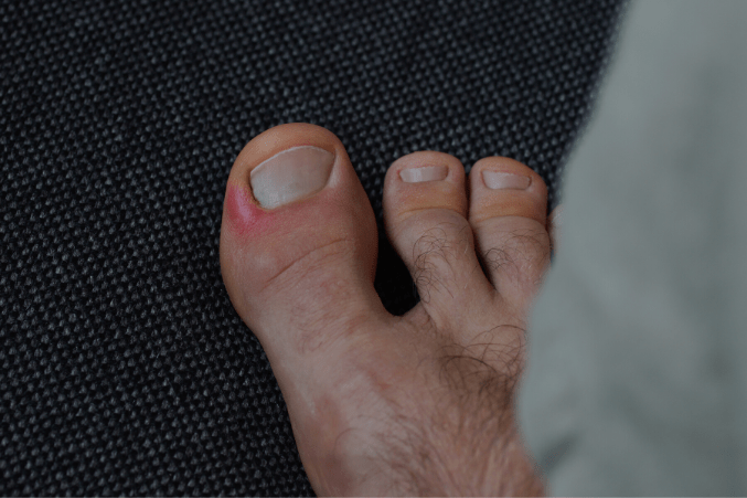 Why Is My Pinky Toenail Thick? Find The Answer Here!