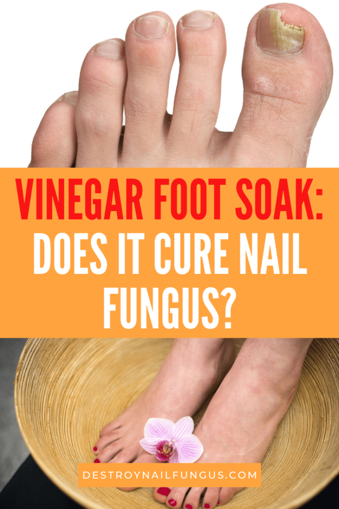 Nail Fungus Remedy Guide How Does Vinegar Kill Fungus?