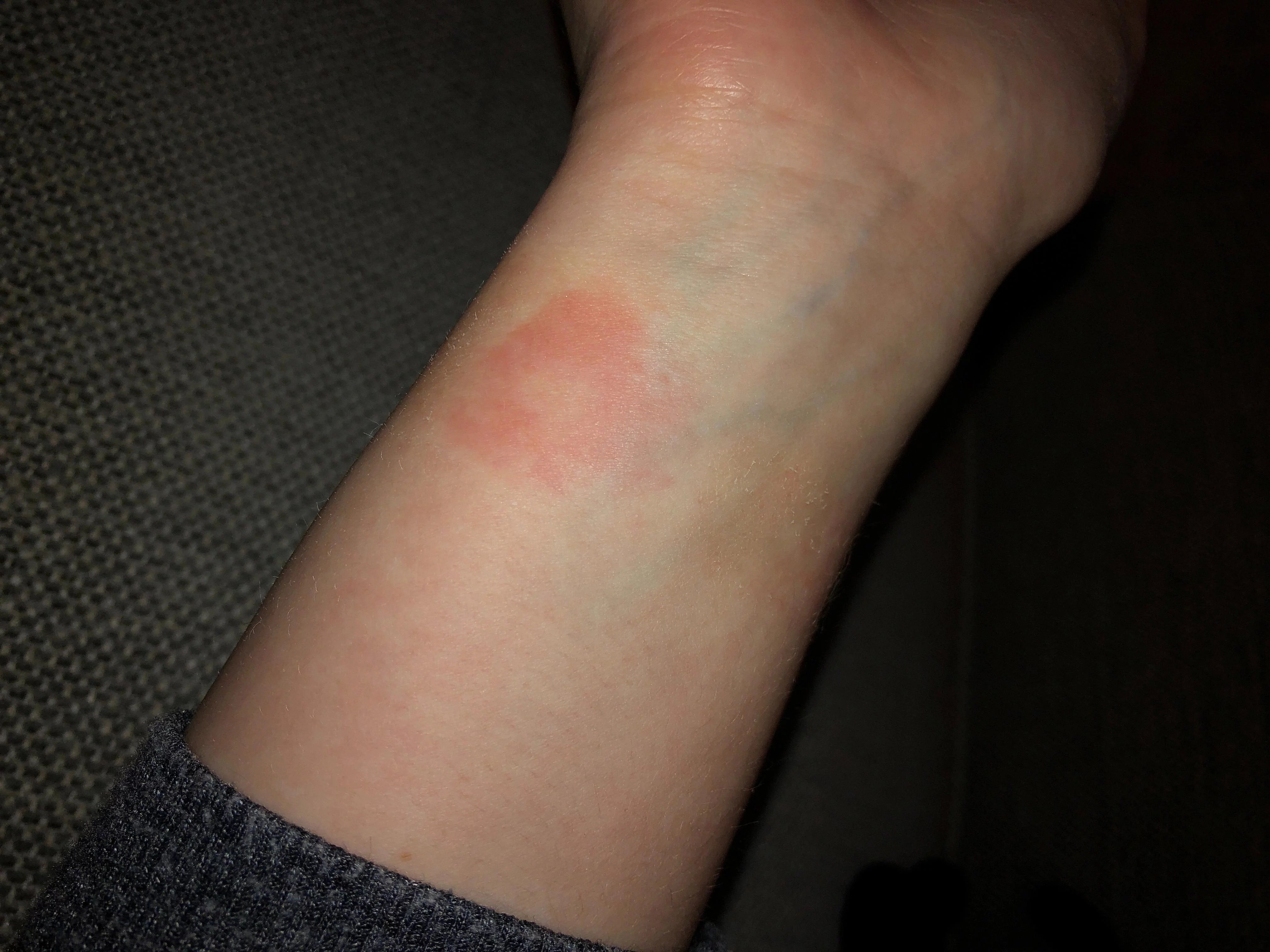 Why Do I Get A Rash After Wearing My Apple Watch ? DeviceMAG
