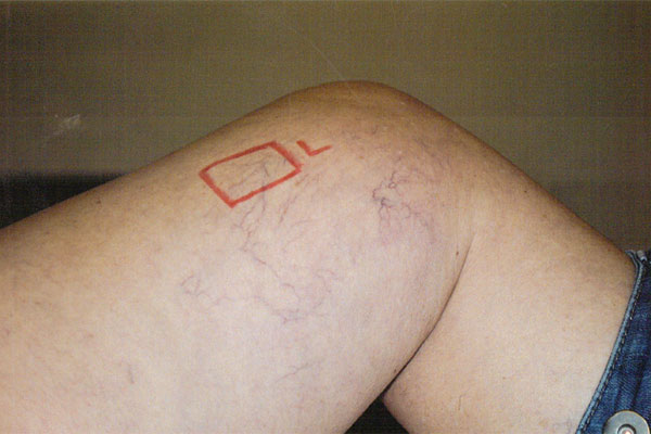 Laser Thread Vein Removal Or Reduction Thread Vein Treatment