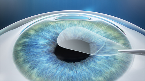 What happens during LASIK eye surgery or laser vision correction