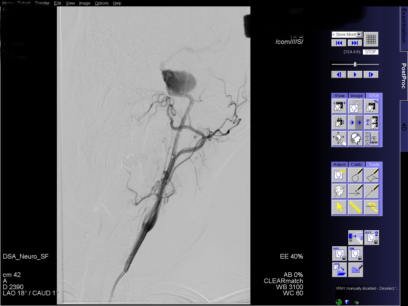ICA embolization with Penumbra coils DHS Hungary
