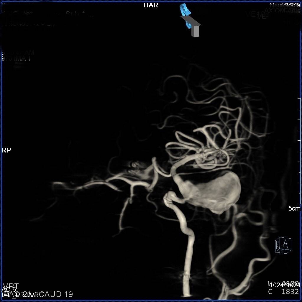 ICA embolization with Penumbra coils DHS Hungary
