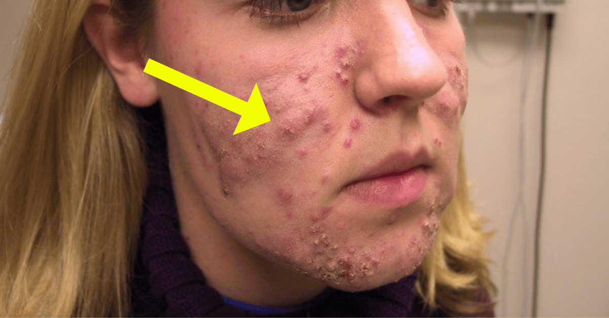 Tratamento para acabar com a acne em 5 dias