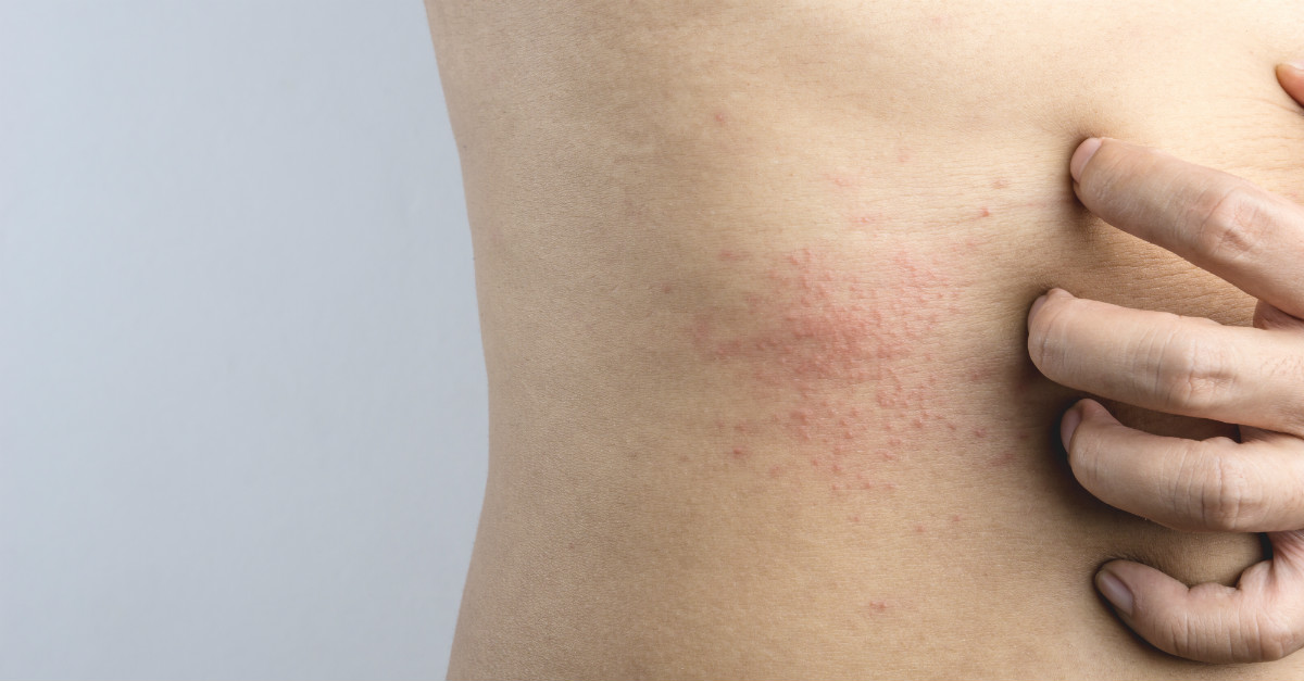 Sarna síntomas, qué es y qué tratamiento existe para curarla