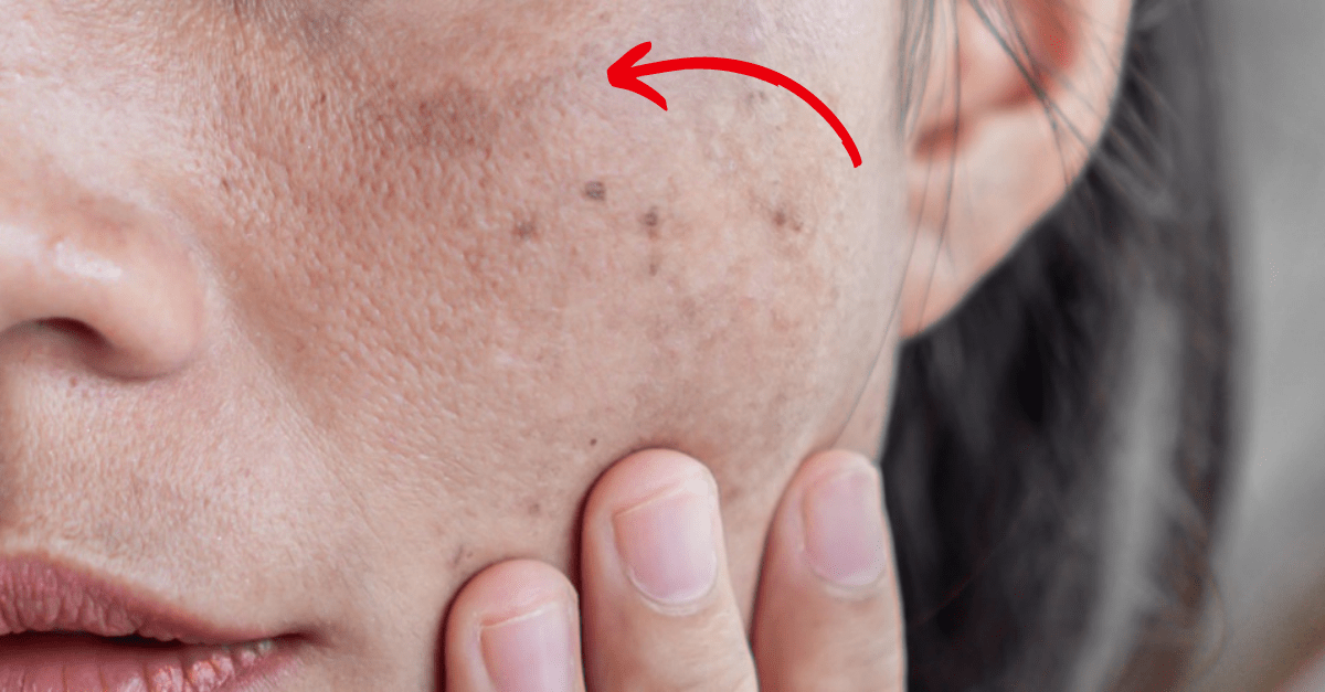 Melasma pode piorar se lavar o rosto com água muito quente?