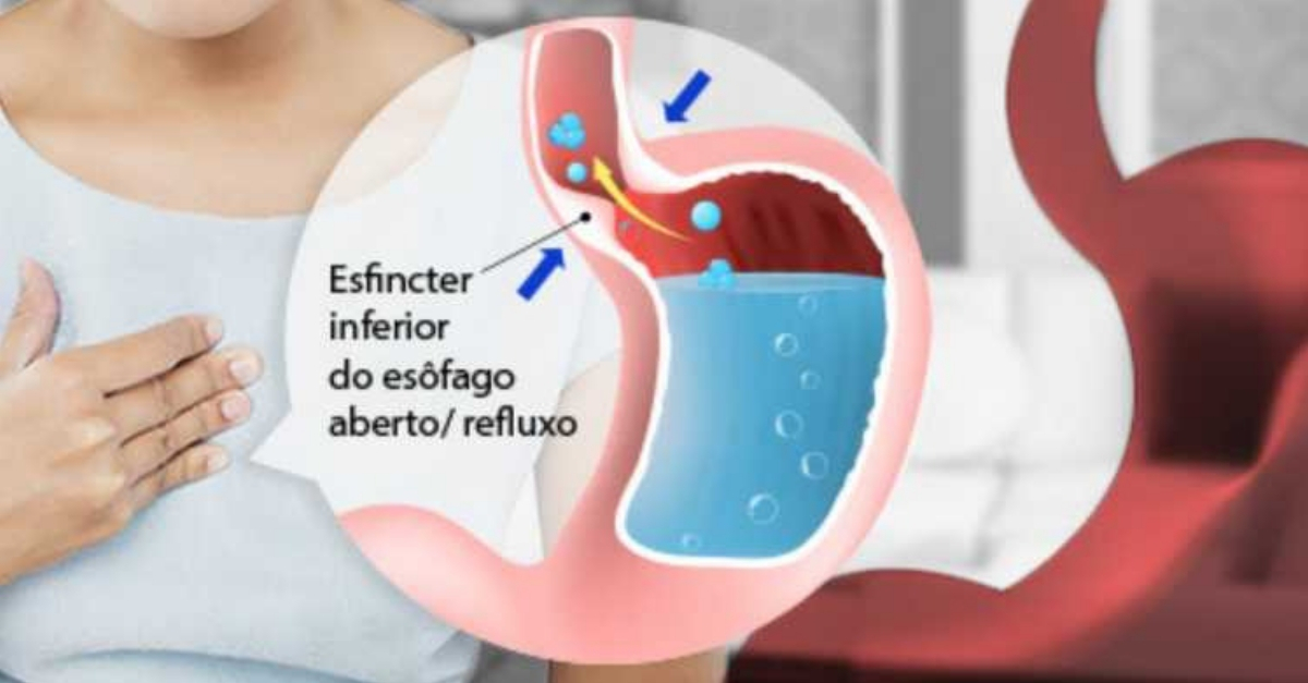 O que comer na dieta para refluxo? Veja os cuidados a ter