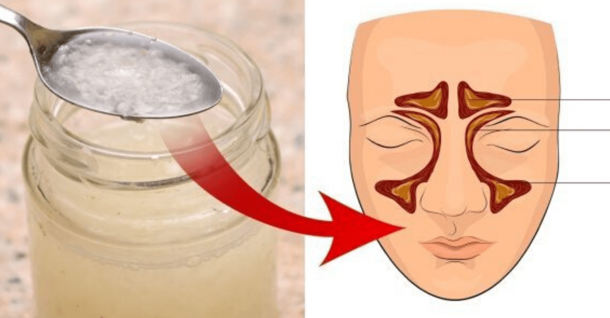 O nabo e o vinagre em ação contra os sintomas de sinusite!