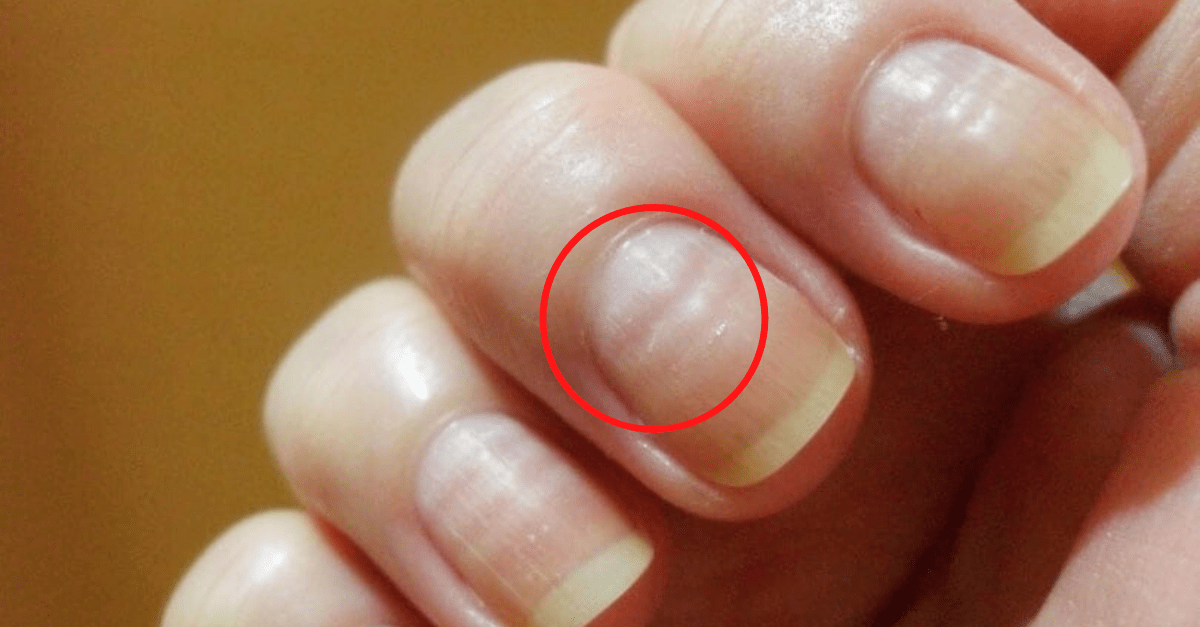Unhas onduladas saiba o que significa e se tem tratamento