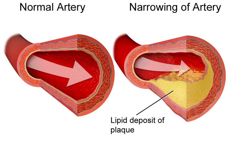 Différence entre le bon (HDL) et le mauvais cholestérol (LDL)