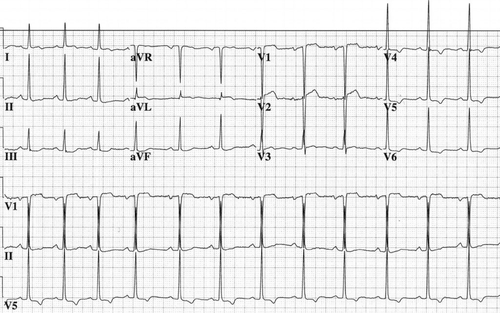 Depresi adalah gangguan mental spesifik yang terlihat dari adanya perasaan sedih, murung, sulit berkonsentrasi dan tidak memiliki motivasi untuk melakukan sesuatu. EKG Part 8 : ST Elevasi bukan karena Infark Miokard ...