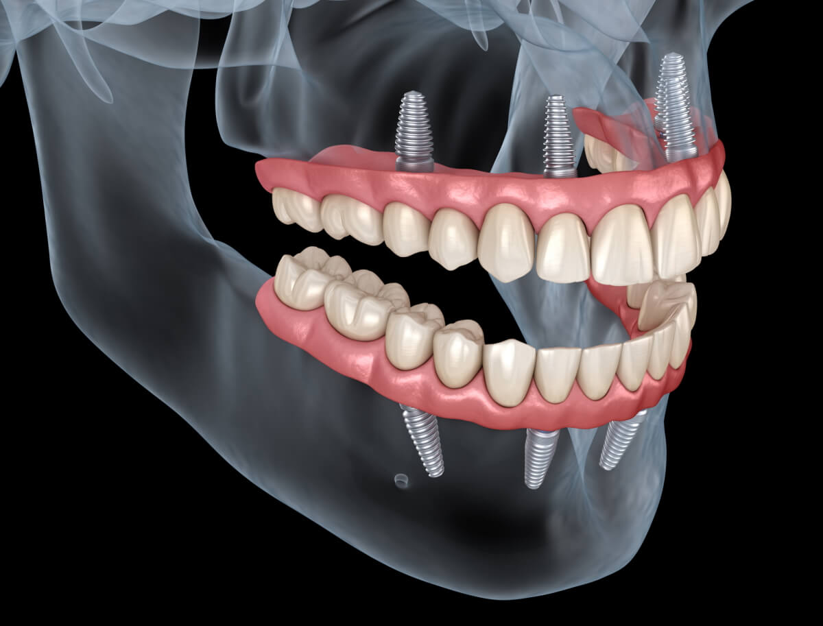 A complete guide for eating after dental implants what can you eat and