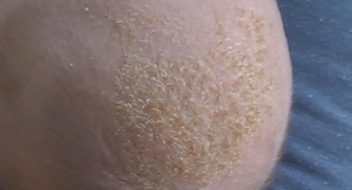 How To Get Rid Of Cradle Cap Here Is The Best Way To Treat Your Baby
