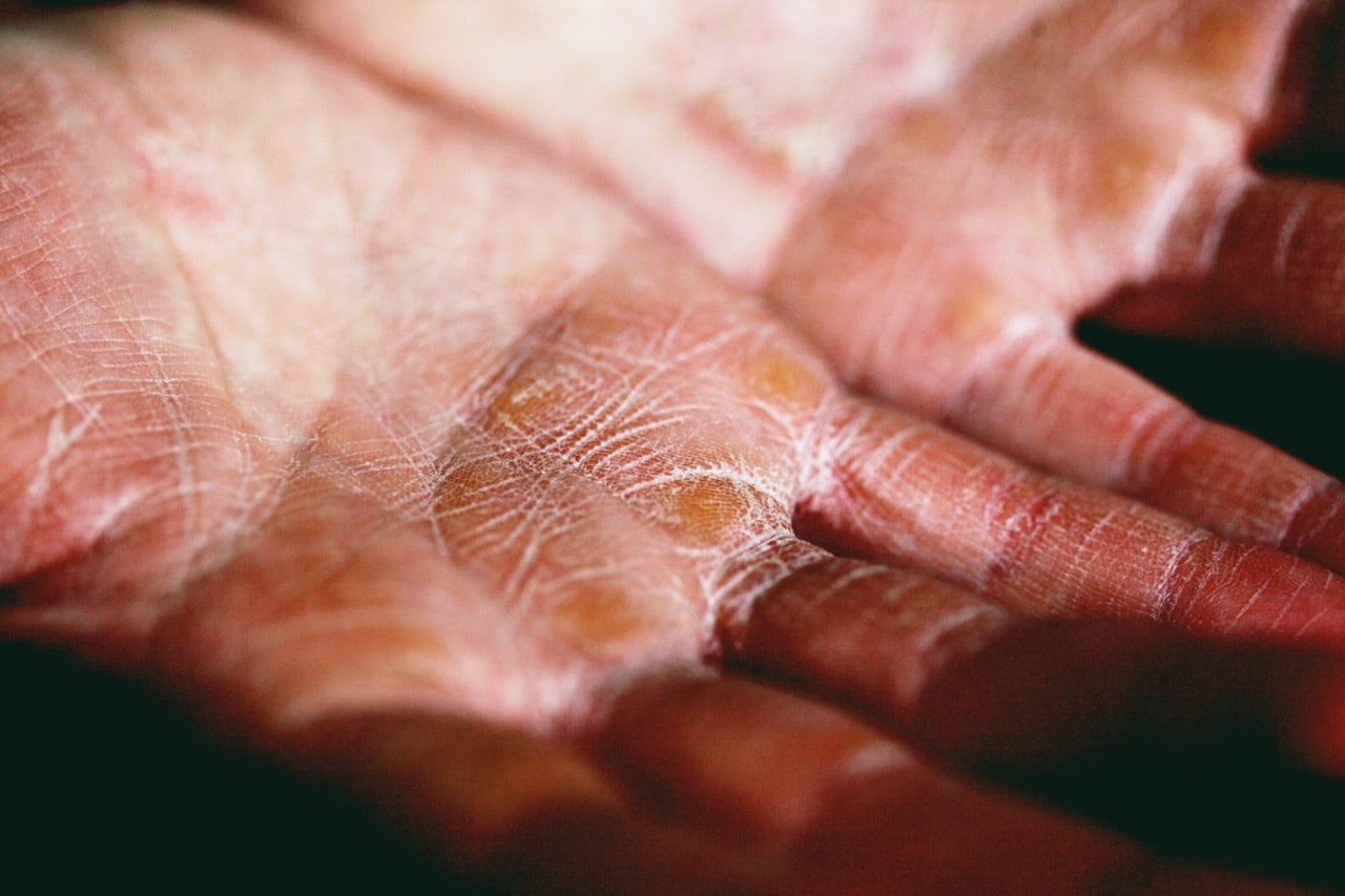 7 Reasons Eczema Flares Up and How to Fix It Aglow Dermatology