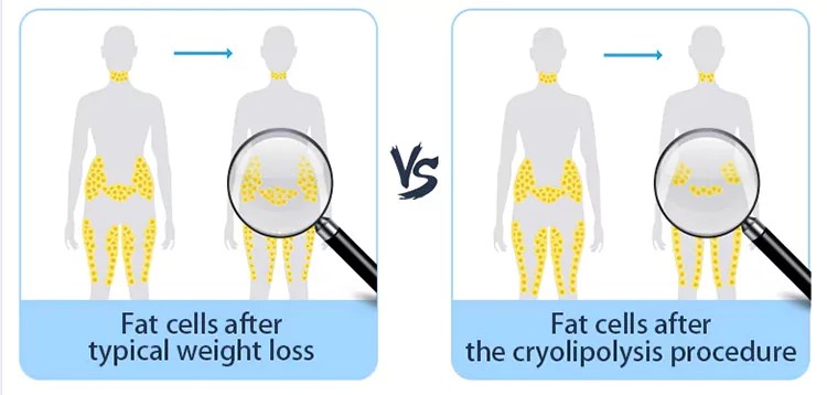 What is Cryolipolysis Machine? - Stelle Laser