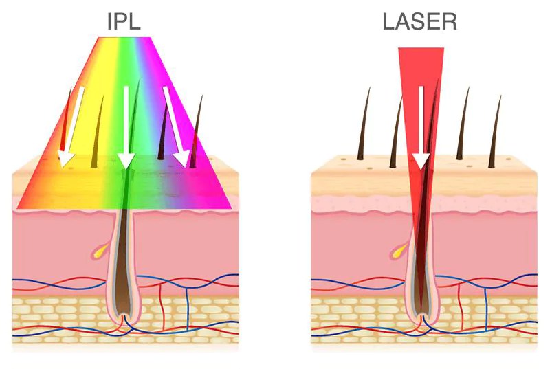 Hair Removal Treatment Lasers & IPL OPT [Manufacturer] Stelle Laser