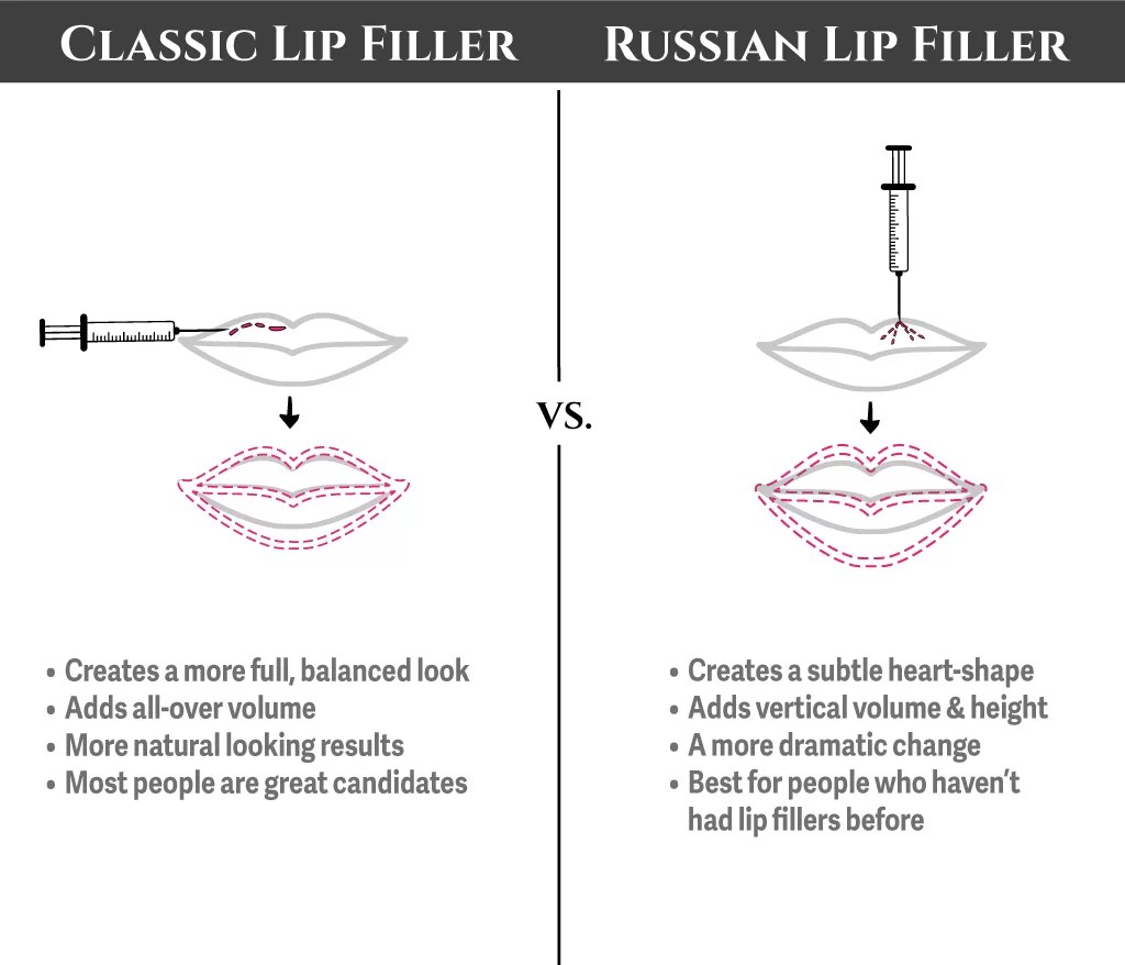 What is the Russian Lip Filler Technique for Lip Augmentation? Direct