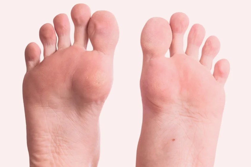 Common Foot Problems Prevention Protecting Your Feet DiseaseFix