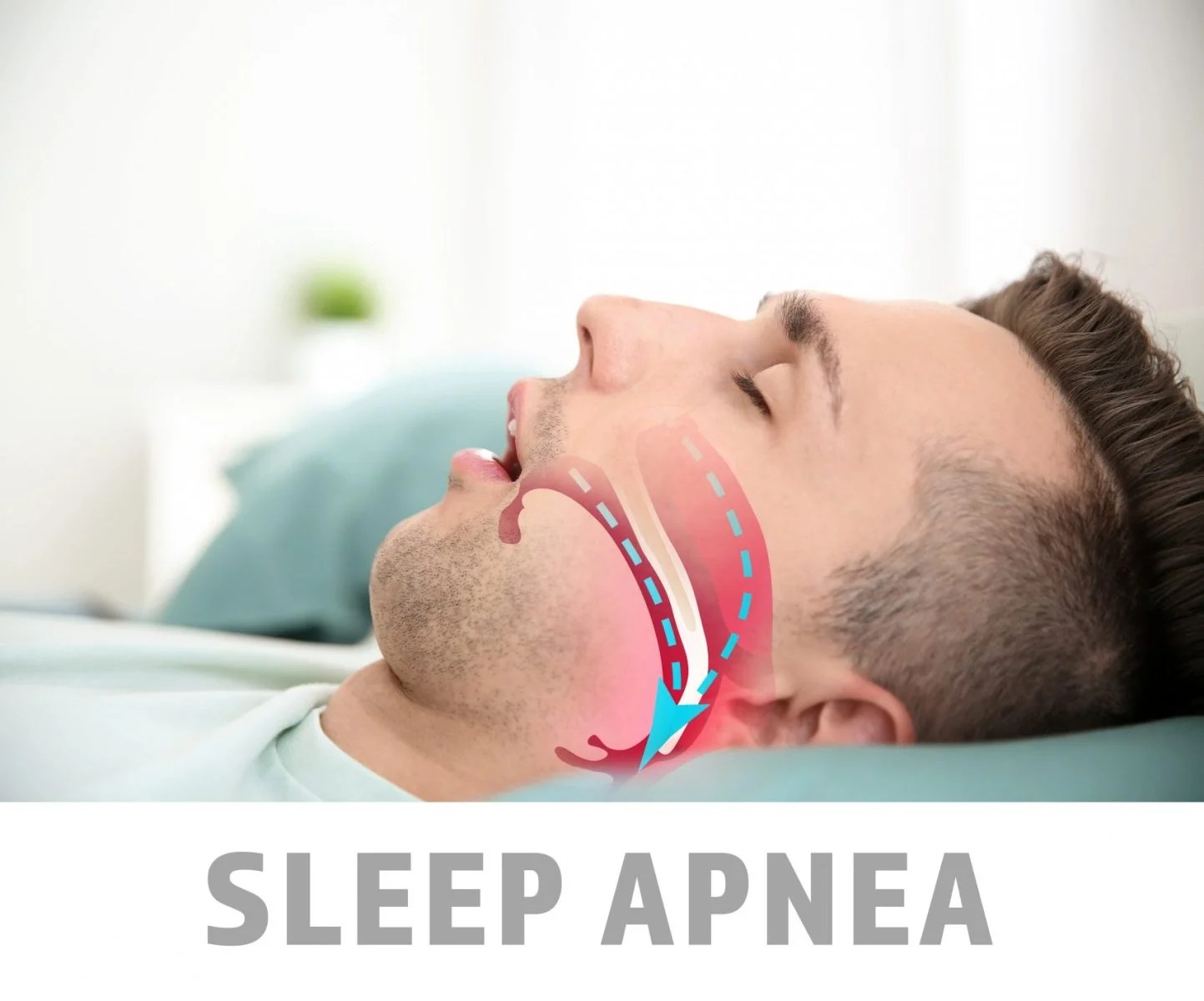 Distinctive Dental Sleep Apnea Causes & Symptoms Crown Point