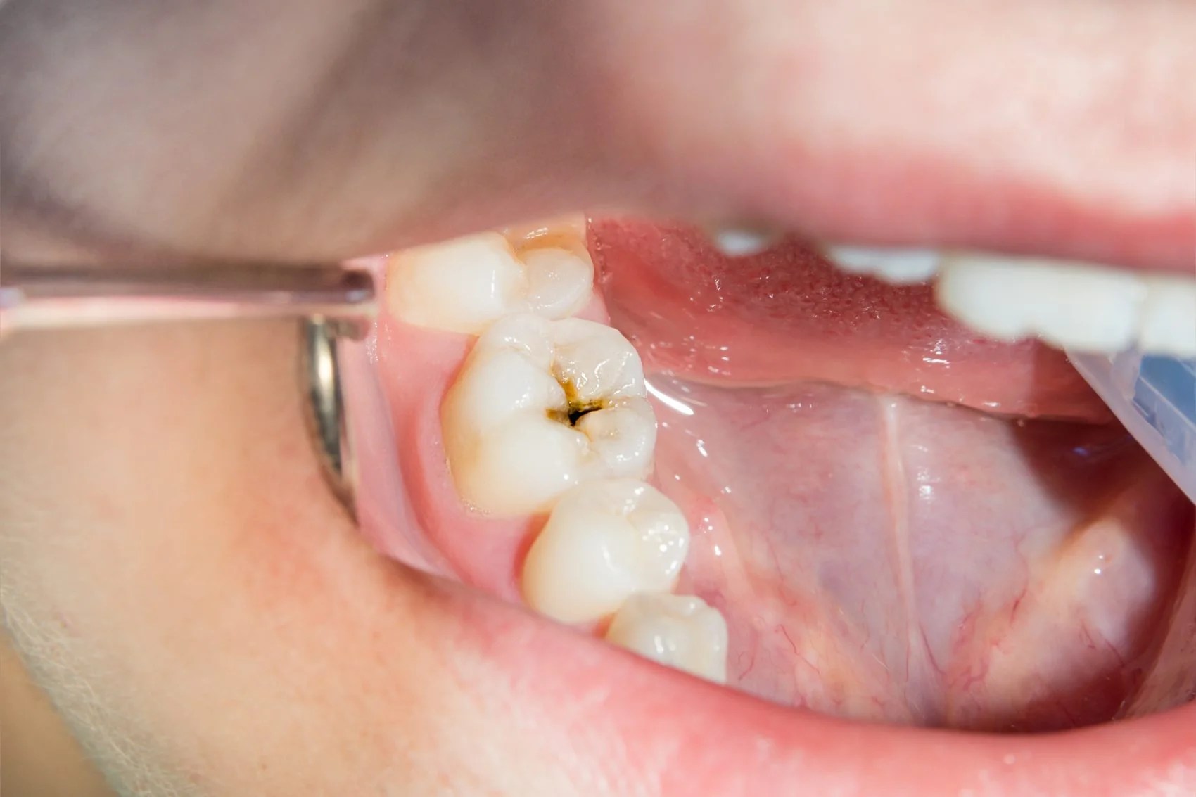 How Long Do Dental Fillings Last? Distinctive Dental Dental Fillings in Cedar Lake