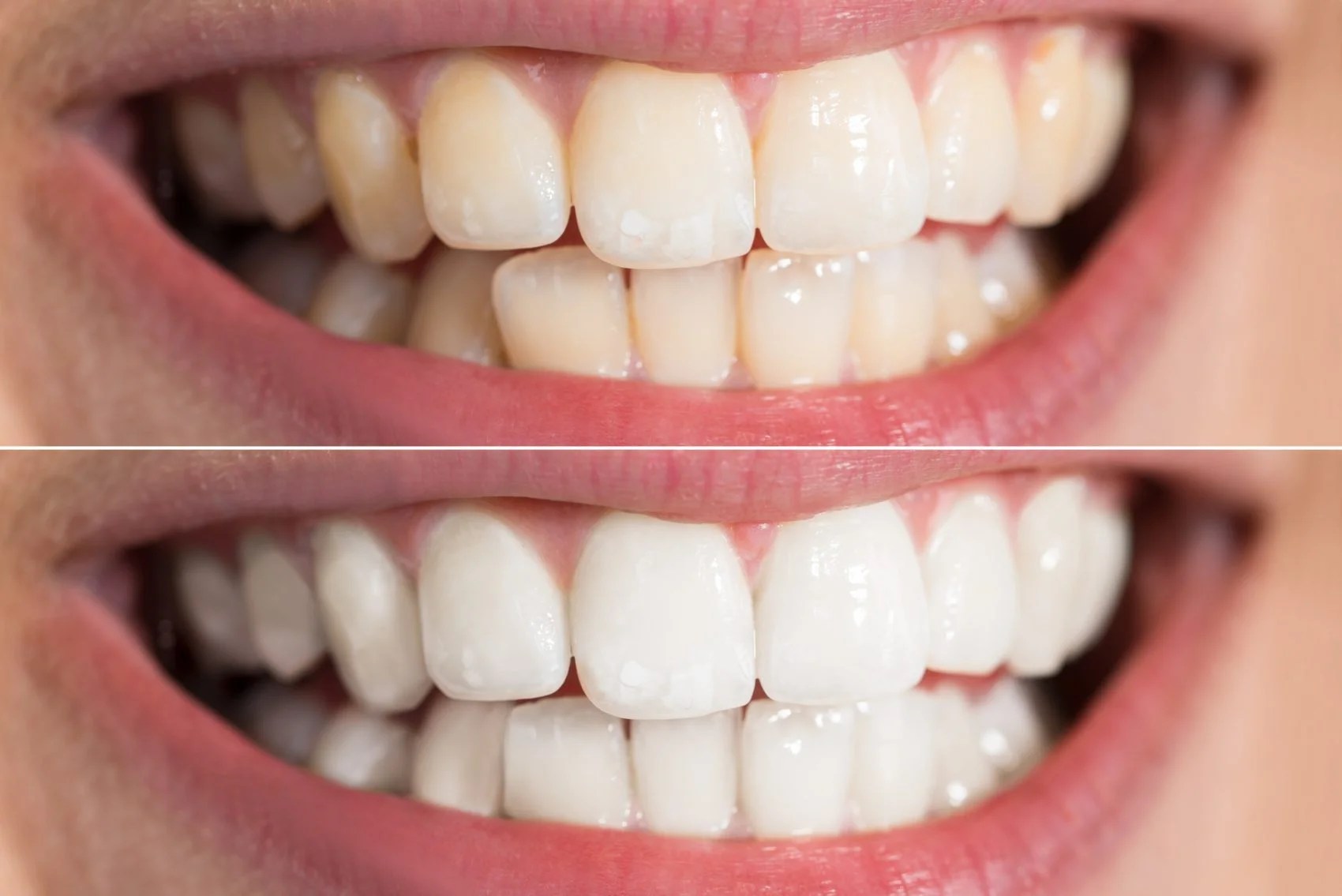 What Should I Know About Whitening My Teeth? Distinctive Dental