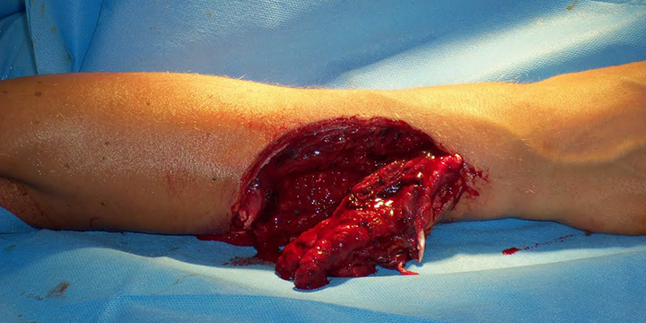 Dive Mentor Stop The Bleed