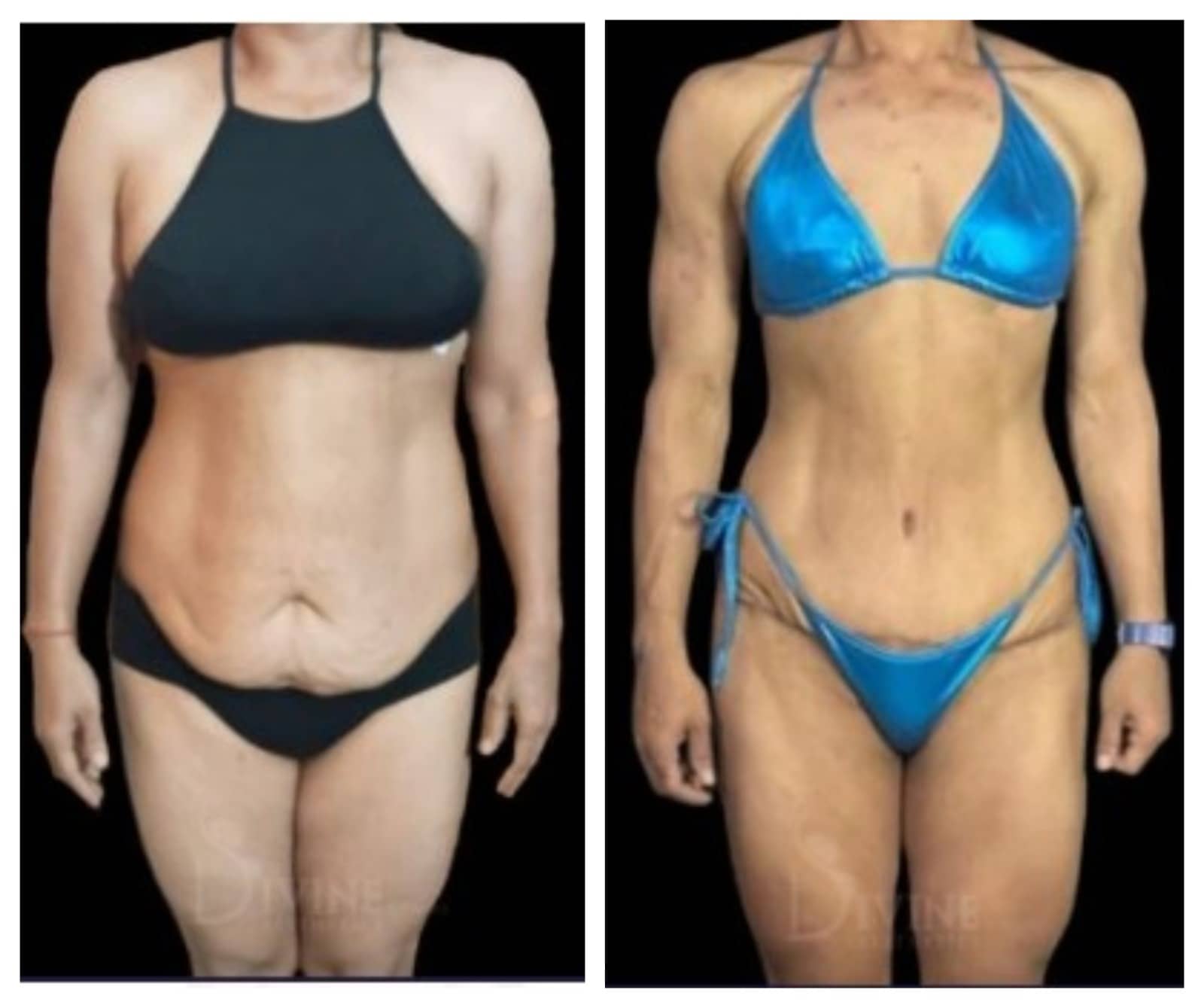 Tummy Tuck Before and After Tummy Tuck Surgery Result