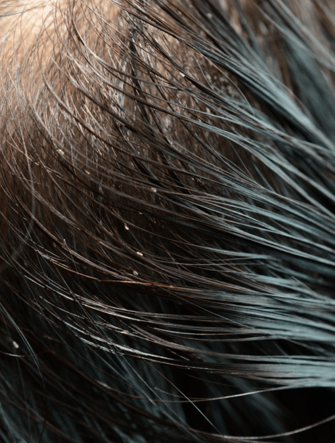 11 Best Home Remedies To Get Rid Of Lice Fast DiyVines Do It Yourself