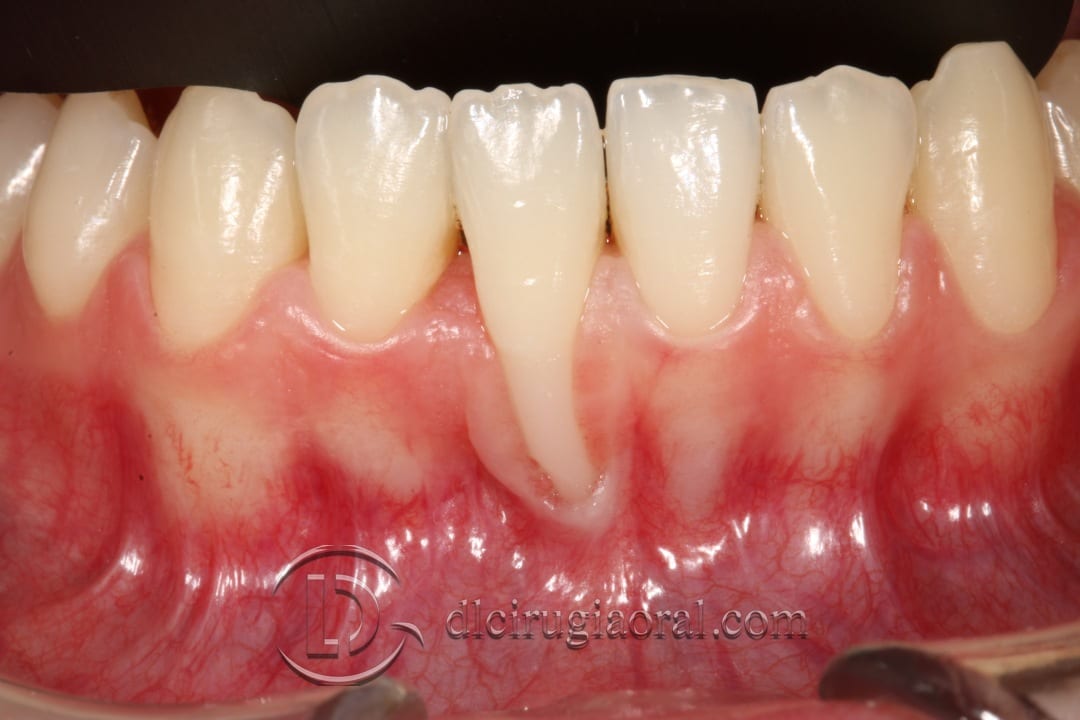 Coverage of a large recession DL Oral Surgery