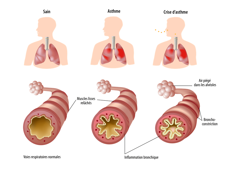 Asthme illustrations médicales Pneumologie Docdeclic