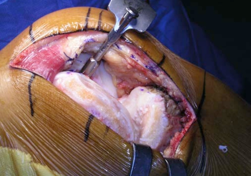 MINI INVASIVE SUBVASTUS KNEE REPLACEMENT DOCJOINTS//DR SUJIT JOS