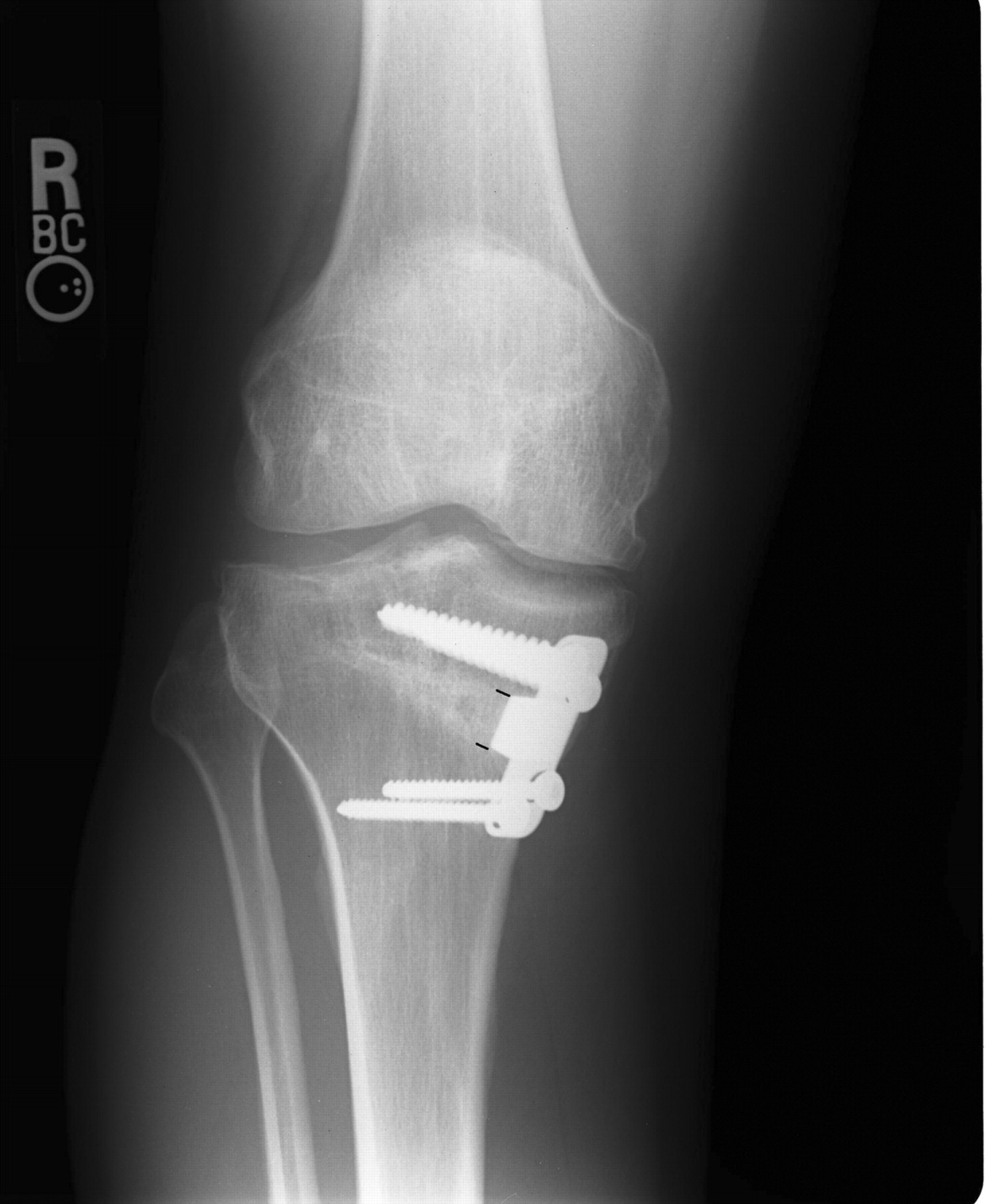 High tibial osteotomy at Kochi, Kerala, India DOCJOINTS//DR SUJIT JOS