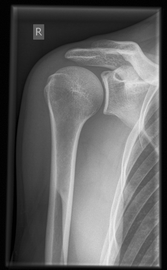 True AP_shoulder DOCJOINTS//DR SUJIT JOS//Joint Surgeon for Knee